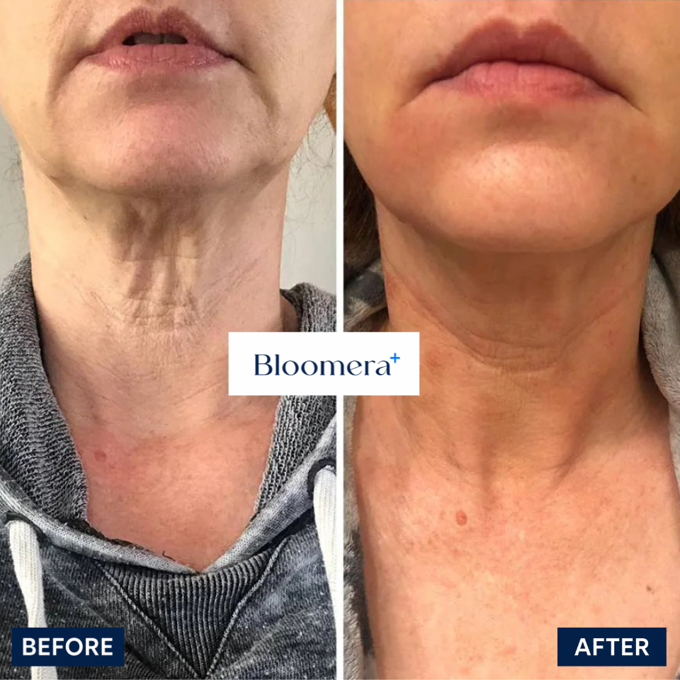 Bloomera NeckTighten Technology®