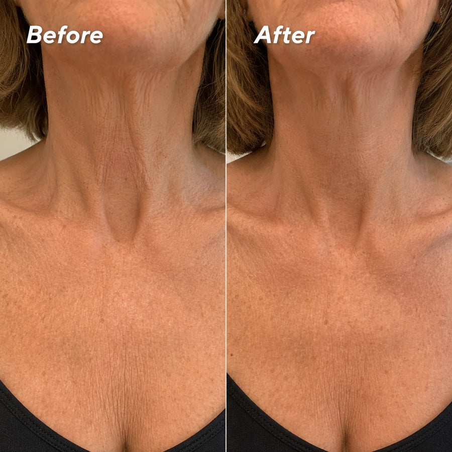 Smooths Crepey Neck Texture